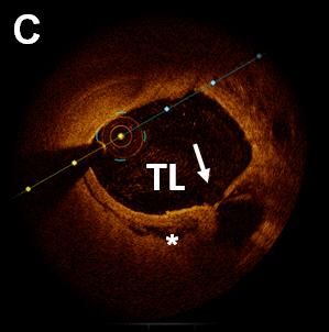 C: Proximal part of dissection with narrowing of the TL.