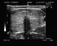 Uneori prezinta noduli bine delimitati de 3-15 mm hiper sau izoecogeni,, cu sau fara calcificari, vascularizatie redusa, frecvent periferica Gusa nodulara