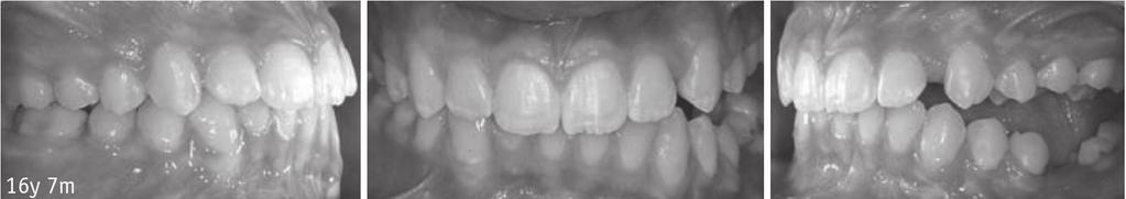 Primary Impaction of Teeth hellenic Orthodontic Review Εικ. 9. Πρωτογενής εγκλεισμός από αποτυχία μηχανισμού ανατολής στο αριστερό ημιμόριο με εμφανή την οπίσθια χασμοδοντία.