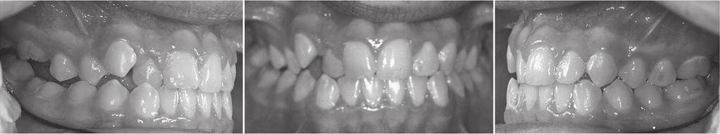 Εικ. 11. Πρωτογενής εγκλεισμός Τύπου ΙΙ. Σημειώνεται η ετερόπλευρη οπίσθια χασμοδοντία δεξιά και η χρονική διαφορά στο δυναμικό ανατολής των προσβληθέντων δοντιών. (Από: Frazier-Bowers και συν.