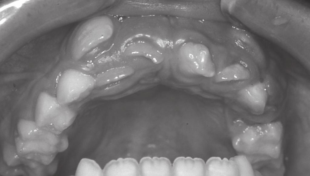δυνατόν να παρεμποδίσουν τη φυσιολογική ανατολή τους με αποτέλεσμα τα δόντια να οδηγηθούν σε μερικό ή πλήρη εγκλεισμό που συχνά αποκαλείται πρωτογενής εγκλεισμός ή και αγκύλωση.