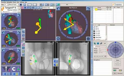 perforation Remote-controlled magnetic pulmonary vein isolation using a new three dimensional non-fluoroscopic