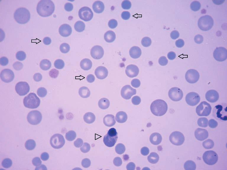 Εικόνα 1. Επίχρισμα αίματος σκύλου. Παρατηρείται ένα στοχοκύτταρο (βέλος) και ένα εχινοκύτταρο (κεφαλή βέλους) (Χρώση Giemsa, 100x αντικειμενικός φακός). Εικόνα 2. Επίχρισμα αίματος σκύλου. Παρατηρείται ένα ζεύγος δακρυοκυττάρων (βέλος) (Χρώση Giemsa, 100x αντικειμενικός φακός).