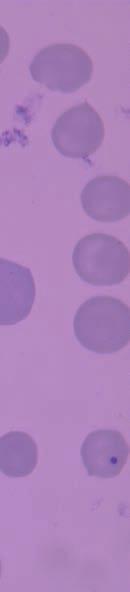 Τροποποιήσεις στα λιπίδια ή στις πρωτεΐνες της κυτταροπλασματικής μεμβράνης των ερυθρών αιμοσφαιρίων οδηγούν στην εμφάνιση ακανθοκυττάρων, στοχοκυττάρων (Εικόνα 1), ελλειπτοκυττάρων και εχινοκυττάρων