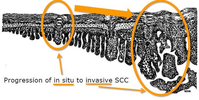 Συσχέτιση μεταξύ AK και SCC 1 Τα ιστοπαθολογικά όρια μεταξύ μιας AK και ενός SCC είναι υποκειμενικά και σχετικά αυθαίρετα Υπάρχει παρόμοια κυτταρολογική εικόνα μεταξύ AKs και SCCs Μια κλινικά