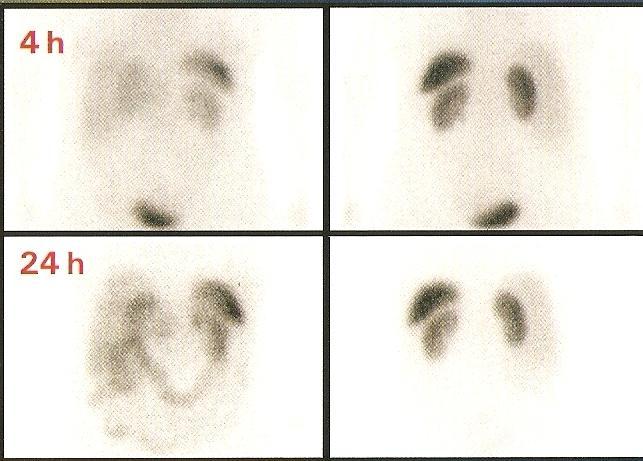 SPECT/CT