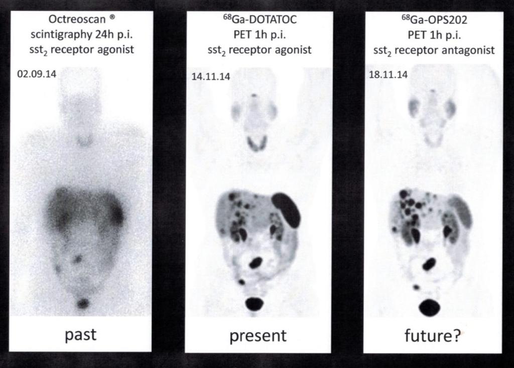Antagonists may provide better end-results 1. Better image contrast 2. Significant increase in the number of detectable lesions 3. Improved tumorto- background uptake ratio 4.