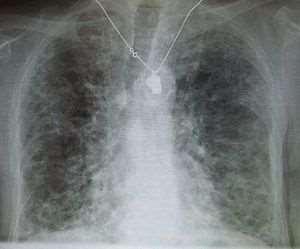 Ορισμός Η πνευμονική ίνωση είναι μια χρόνια νόσος του πνεύμονα, κατά την οποία ο