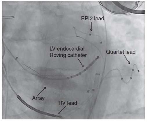 A comparison of left ventricular endocardial, multisite, and multipolar epicardial cardiac resynchronization: an acute haemodynamic and electroanatomical study 15 ασθ, 67% με ΣΝ, 3 μήνες