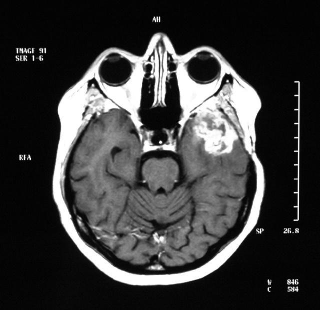 Alexiou et al. NeuroOncol.