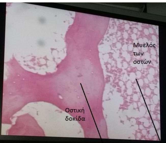 + 20. Σπογγώδης (δοκιώδης) οστίτης ιστός Οστική δοκίδα (ροζ) Οστικό βοθρίο (λευκο) Μυελός των οστών