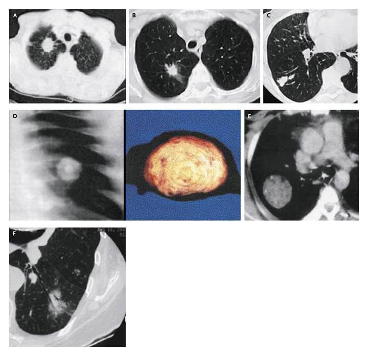 Images of Solitary Pulmonary Nodules Ost