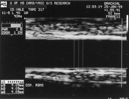 (HD) FMD = HD - RD RD Corretti M,