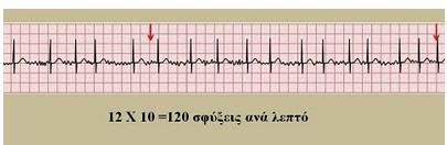 Σχήμα 2.8 α - Υπολογισμός καρδιακής συχνότητας σε ρυθμικό ΗΚΓ Εφόσον το ΗΚΓ δεν είναι ρυθμικό, προσδιορίζεται στο χαρτί χρονικό διάστημα που αντιστοιχεί σε 6 δευτερόλεπτα.