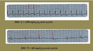 3 ΑΝΑΛΥΣΗ ΗΚΓ ΚΑΙ ΟΙ ΚΥΡΙΟΤΕΡΕΣ ΕΝΝΟΙΕΣ 2.3.1 ΦΥΣΙΟΛΟΓΙΚΟ ΗΛΕΚΤΡΟΚΑΡΔΙΟΓΡΑΦΗΜΑ Κατά την επέκταση του επάρματος της καρδιακής διέγερσης στα διάφορα τμήματα αυτής, ηλεκτρικά ρεύματα διατρέχουν τους