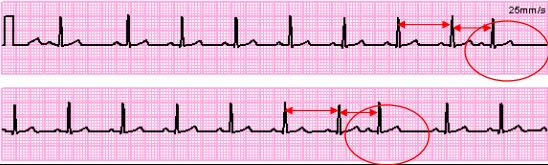 Σχήμα 2.10 ΗΚΓ ασθενή με Atrial Premature beats 2.4.