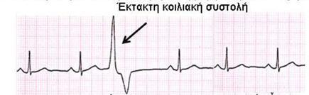 ερέθισμα του φλεβοκόμβου, τότε η διέγερση αυτή της καρδιάς ονομάζεται έκτακτη (πρόωρη) κοιλιακή συστολή. Οι έκτακτες αυτές μπορεί να είναι αραιές η συχνές.