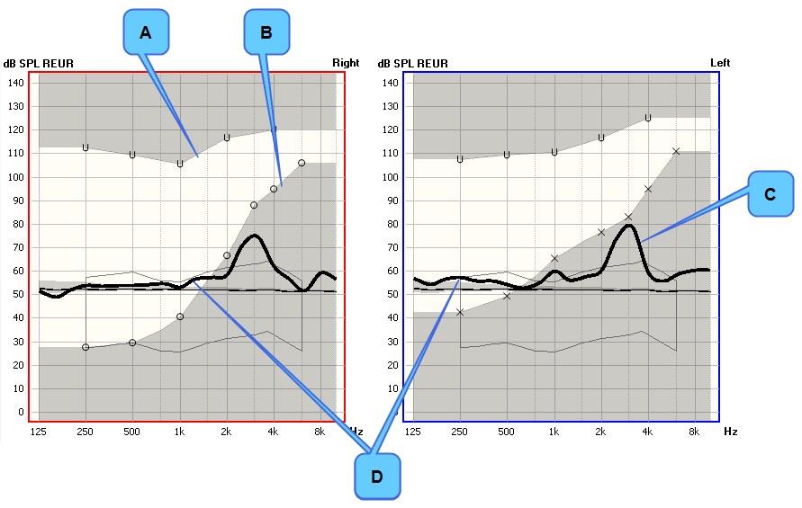 A. UCL B. Ακοόγραμμα C. Κορυφή γύρω στα 3 khz D. Καμπύλη μέτρησης 13.