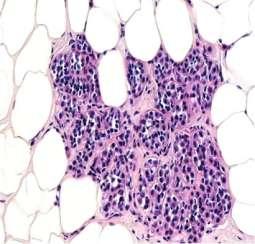 κυτταρολογία έχουν μεγαλύτερο κίνδυνο ανάπτυξης διηθητικού καρκινώματος σε σχέση με ασθενείς με μικρότερους όγκους ή με in situ λοβιακό καρκίνωμα. (1) Α Β Εικόνα 1.