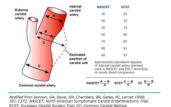 Εικόνα 2: Μέθοδοι εκτίμησης του βαθμού καρωτιδικής στένωσης κατά NASCET, ECST και CC 2.1 Ψηφιακή Αγγειογραφία Η ψηφιακή αγγειογραφία είναι η εξέταση εκλογής για την απεικόνιση των καρωτίδων.