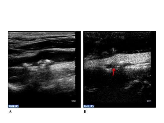 Εικόνα 7: Α: Αθηρωματική πλάκα μικτής ηχογένειας στο οπίσθιο τοίχωμα της καρωτίδας στο ύψος του διχασμού Β: Η ίδια αθηρωματική πλάκα μετά τη χορήγηση ουσίας ηχοαντίθεσης.