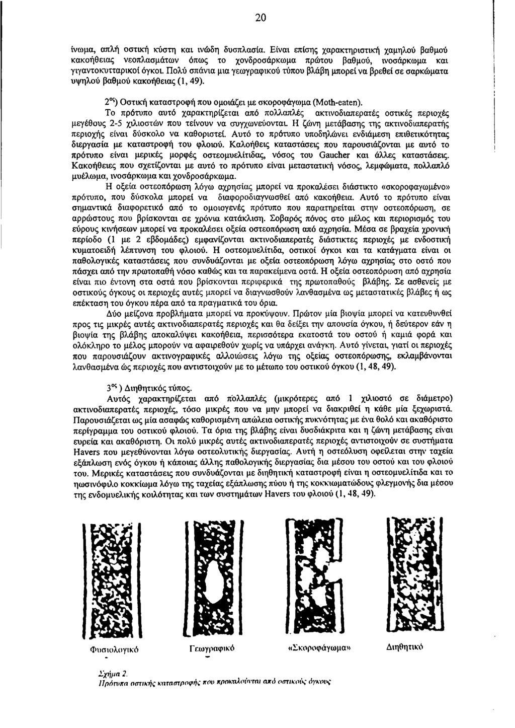 20 ίνωμα, απλή οστική κύστη και ινώδη δυσπλασία. Είναι επίσης χαρακτηριστική χαμηλού βαθμού κακοήθειας νεοπλασμάτων όπως το χονδροσάρκωμα πρώτου βαθμού, ινοσάρκωμα και γιγαντοκυτταρικοί όγκοι.