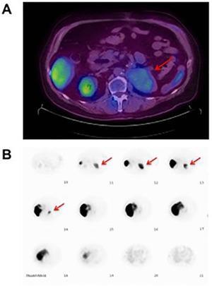 (A) 18F-FDG PET/CT (B) Μελέτη με Tc-99m-sulfur colloid Ύποπτη μάζα μαλακών ιστών κοντά στον ΑΡ νεφρό (ΡΕΤ απεικόνιση) Αντιστοιχεί στον σπλήνα Source: Emanuels
