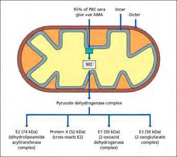 10 ΠΡΩΤΟΠΑΘΗΣ ΧΟΛΙΚΗ ΚΙΡΡΩΣΗ (ΠΧΚ) PRIMARY BILIARY CIRRHOSIS (PBC) Η Πρωτοπαθής Χολική Κίρρωση (ΠΧΚ) είναι ένα βραδέως εξελισσόμενο, αυτοανόσου αρχής, χολοστατικό νόσημα του ήπατος, που κατά κύριο