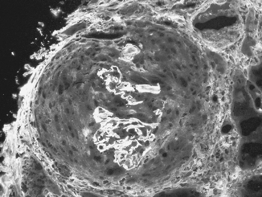 Immunofluorescence microscopy. Note linear deposition of IgG along capillary wall. Goodpasture GBM 6mg dl 50 0.5 g day, 3 PSL 0.