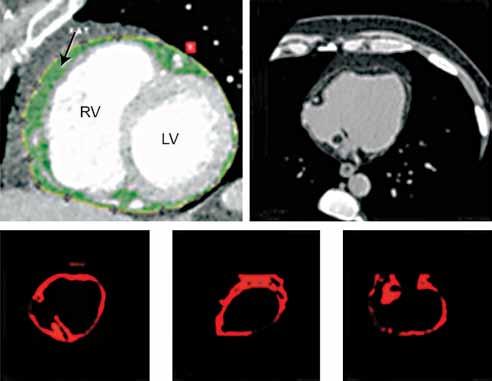 Ι. Βασιλειάδης και συν. Εικόνα 1. Μέτρηση και ποσοτικοποίηση του επικαρδιακού λίπους από την αξονική τομογραφία της καρδιάς. RV: Δεξιά κοιλία. LV: Αριστερή κοιλία.
