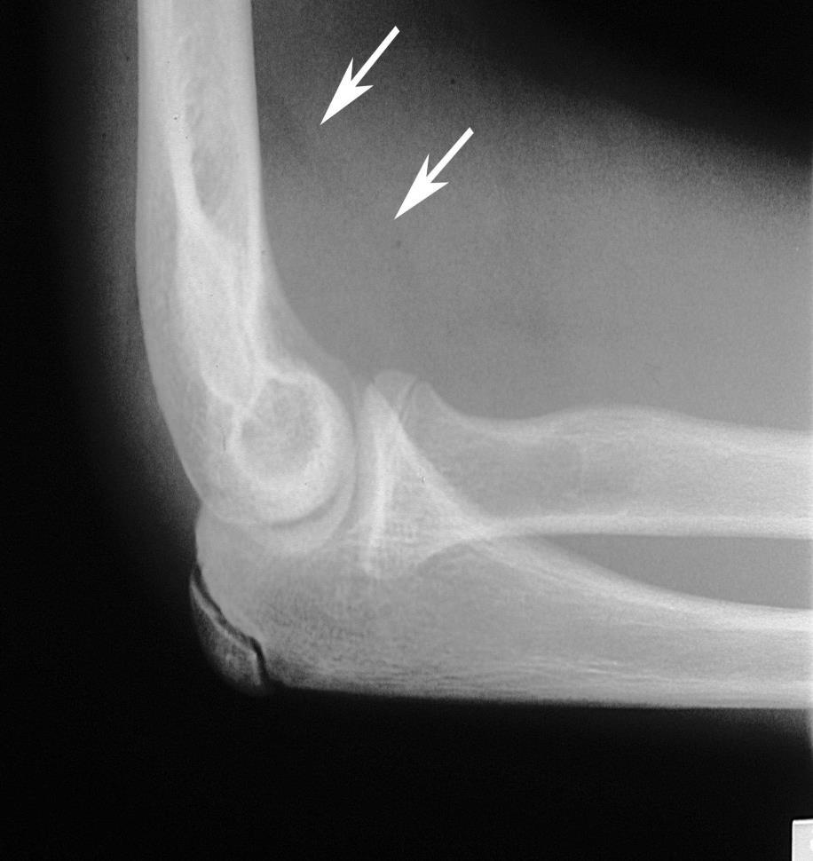 επιφφςεων) Musculoskeletal complications of