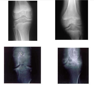 Arnold-Hilgartner classification Stage 1 Stage 2 Stage 3-4 Stage 5 Musculoskeletal