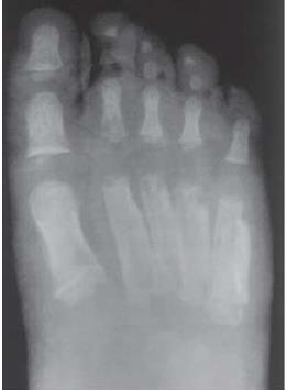 complications of Haematological