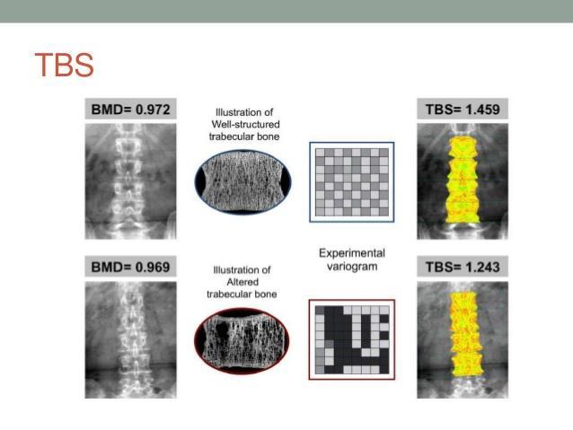 Trabecular Bone Score (TBS) > 1,35 Normal 1,2 1,35 Partially Degraded < 1,2 Degraded Trabecular Bone Score: A