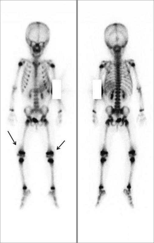 Φυσιολογικό σπινθηρογράφημα οστών σε παιδί Ήπια πρόσληψη στους μαλακούς ιστούς στην περιοχή των γονάτων (βέλη) Source: Lee