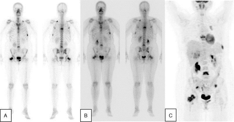 Ασθενής με καρκίνο μαστού και οστεοβλαστικές μεταστάσεις Σπινθηρογράφημα οστών προ (A) και μετά (B) την εφαρμογή θεραπείας ΡΕΤ απεικόνιση με 18F-FDG (C) εντός δύο εβδομάδων από το δεύτερο