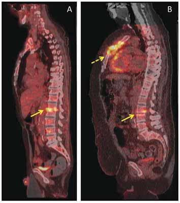 18F-FDG PET/CT απεικόνιση των λοιμώξεων των