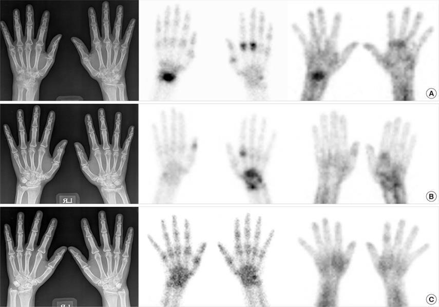 Bone Scintigraphy in the Diagnosis of Rheumatoid Arthritis: Is There Additional Value