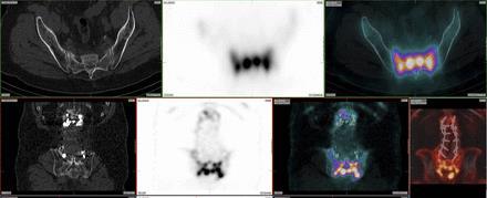 Use of SPECT/CT with 99mTc-MDP bone scintigraphy