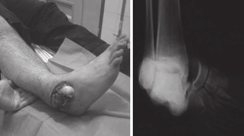 24 E.E.X.O.T., Volume 65, Issue 1, 2014 Figure 1: The first suffered from open dislocation after a kick on the ankle joint (left).