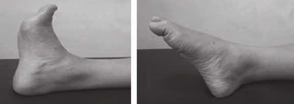 26 E.E.X.O.T., Volume 65, Issue 1, 2014 Figure 5: Normal range of supination (left) and pronation (right) of the second patient s ankle six months after the injury.