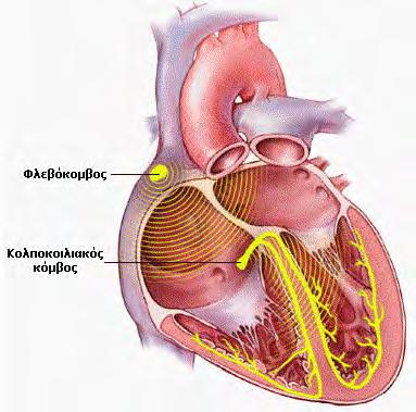 19 Δεμάτιο του His Το ηλεκτρικό σήμα μετά τον κολποκοιλιακό κόμβο, μεταφέρεται μέσω του ειδικού ερεθισματαγωγού ιστού των κοιλιών, που ονομάζεται δεμάτιο του His στις κοιλίες.