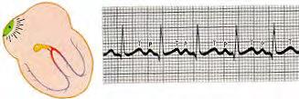 26 Τι είναι αρρυθμία; Φυσιολογικά η καρδιά διεγείρεται από τον φλεβόκομβο. Το ερέθισμα μετά διαχέεται στους κόλπους και τους ερεθίζει (κολπική συστολή).