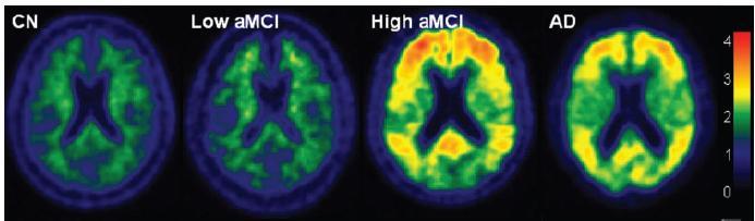 χέση αμυλοειδούς (PIB) και ατροφίας (MRI) Μετωπιαίοι λοβοί Πρόσθια και μέση κροταφική περιοχή Κροταφο-βρεγματική Αμυλοειδές Ατροφία Η φπαρξη αμυλοειδοφσ προηγείται