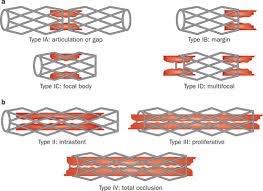 Angiographic In-stent Restenosis