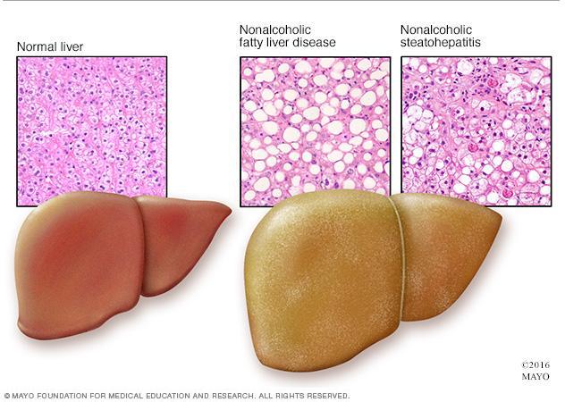 Εικόνα 1.1.1 : Τγιζσ ιπαρ, ιπαρ με NAFLD και ιπαρ με NASH, όπωσ φαίνονται ςτο μικροςκόπιο 5.