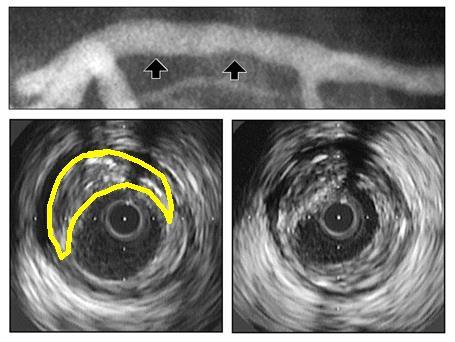 Intravascular Ultrasound (IVUS) Advantage: Reveals the morphology of the plaque Differs between soft (hypo-echoic) and Hard