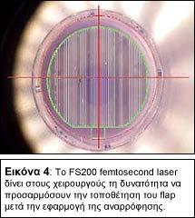 Προσαρμόσιμη επιπέδωση Το FS200 laser επιτρέπει στο χρήστη να προσαρμόσει το μέγεθος του spot, το βάθος και την ενέργεια που μεταφέρεται από την ακτίνα του.