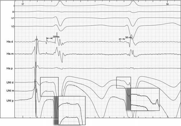 Case Report: Successful Catheter Cryoablation of Hisian Ectopy The successful