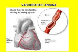 Διάγνωση Αγγειοσυσπαστική στηθάγχη (Vasospastic angina,